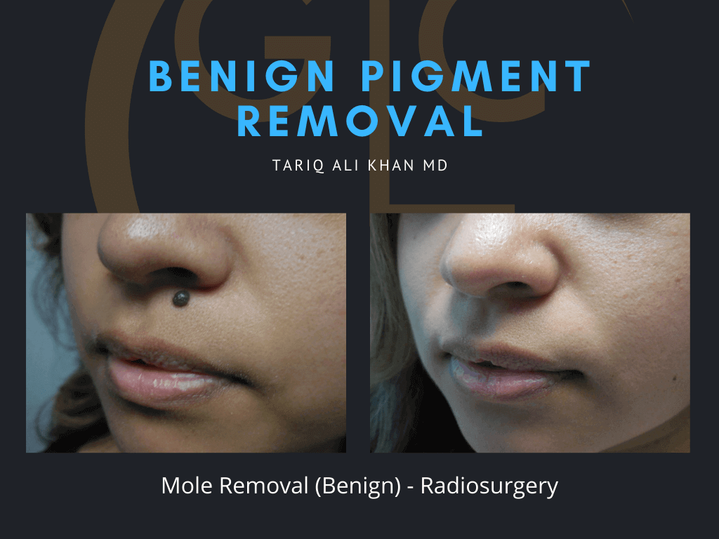 Gentle Care Laser Tustin Before and After picture - Mole Removal